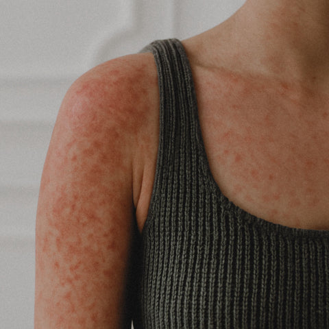 The Connection Between Stress and Skin Sensitivities: A Holistic Approach